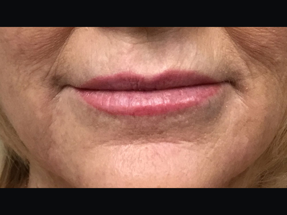 Filler Injections for Face Before & After Gallery - Patient 16689055 - Image 2