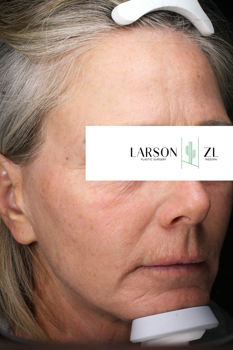 Laser Before & After Gallery - Patient 140819523 - Image 2