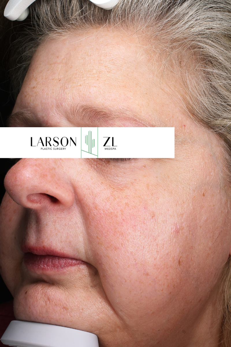 Laser Before & After Gallery - Patient 140819527 - Image 1