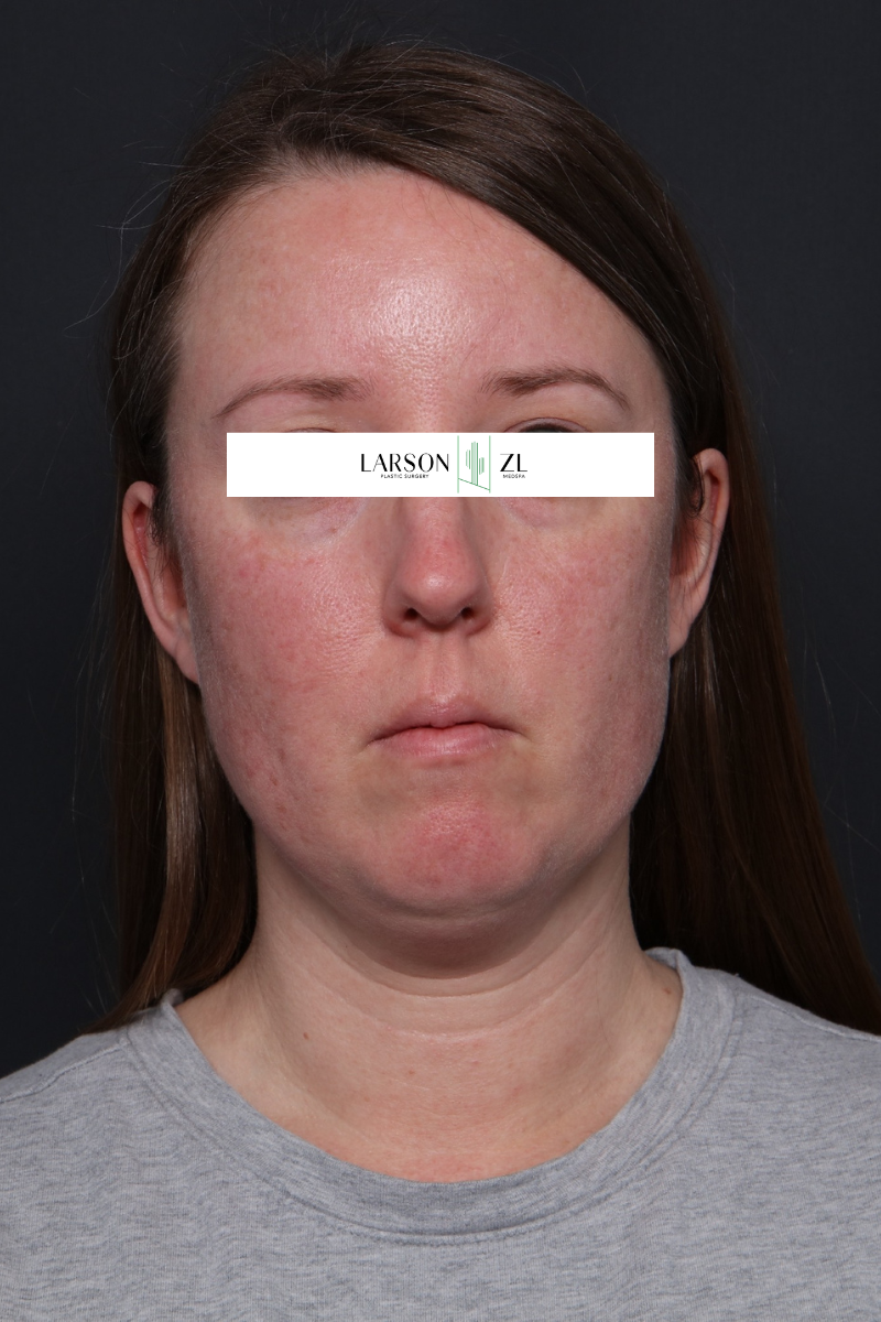 Laser Before & After Gallery - Patient 140819537 - Image 1