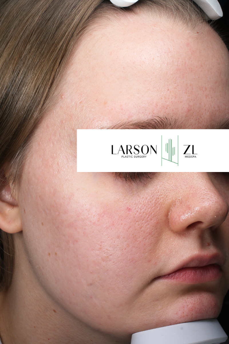 Acne & Acne Scarring Before & After Gallery - Patient 140819572 - Image 2